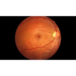 Retinal Cameras All Types